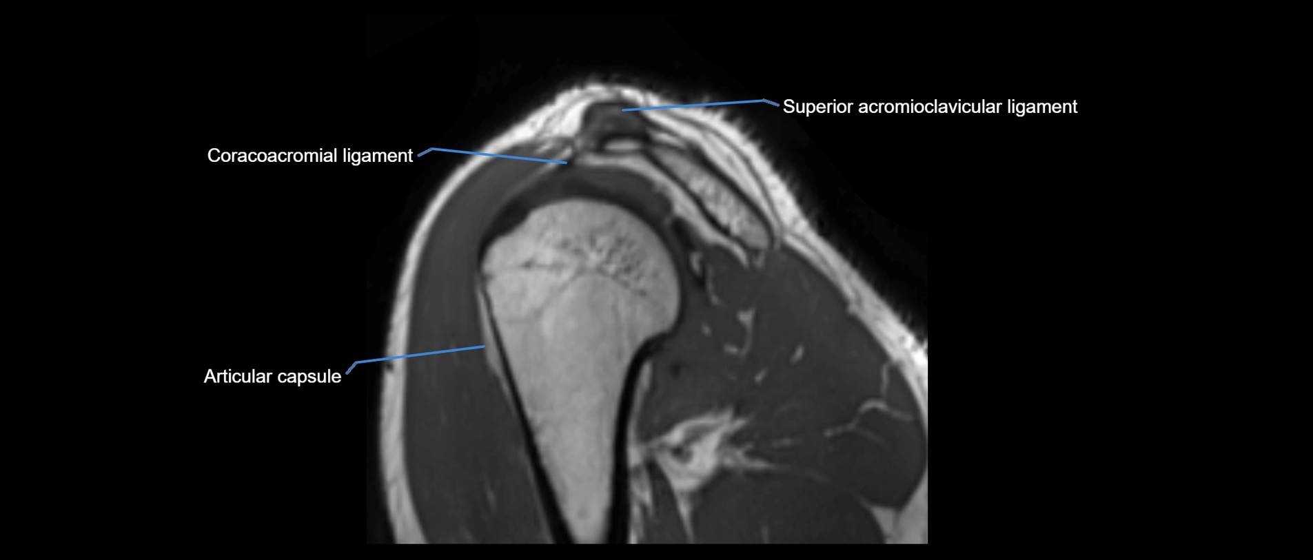 shoulder ligaments sagittal  cross sectional anatomy 3T MRI AI enhanced radiology image -img-00001-00043.webp